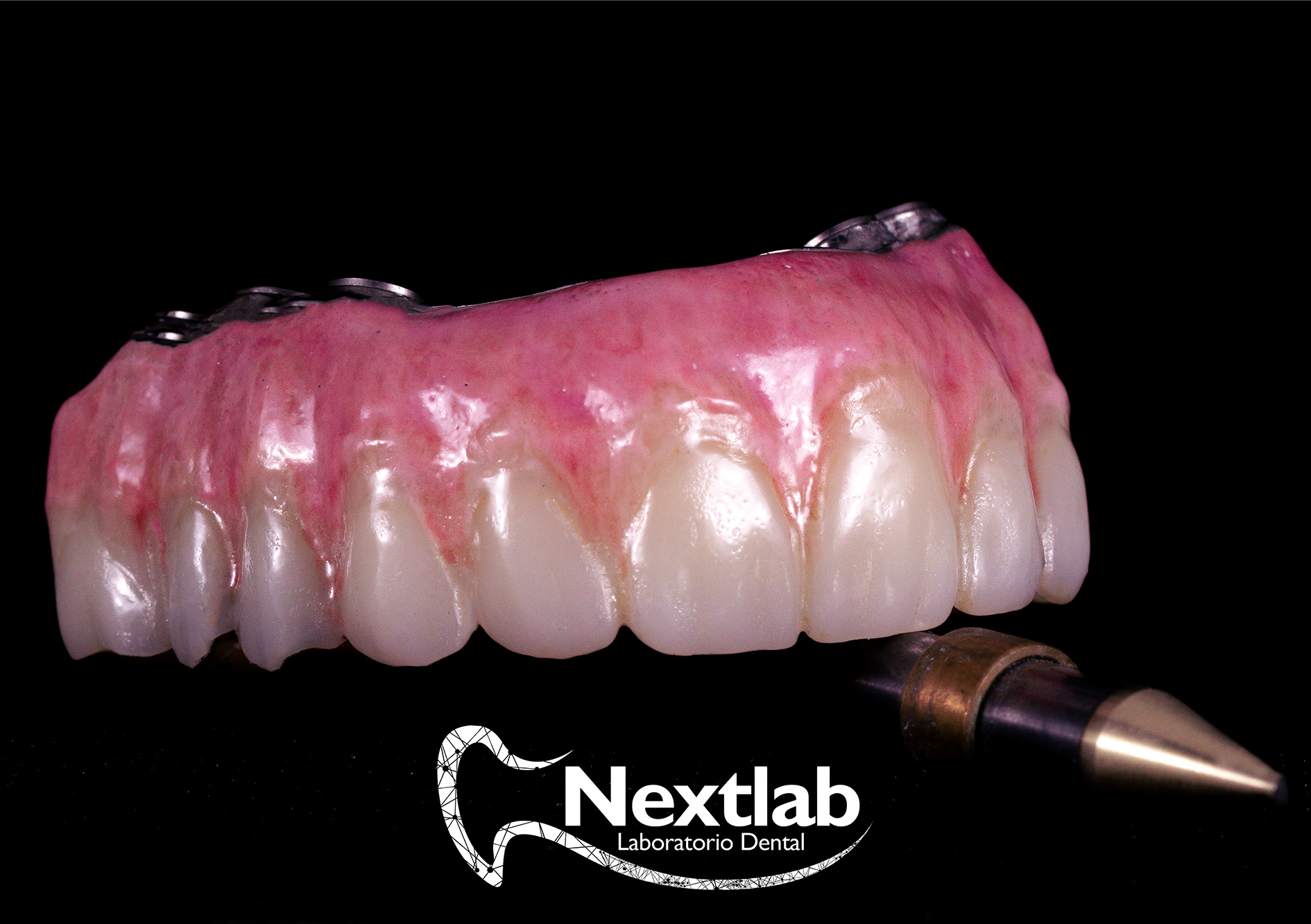 Protesis fija sobre implantes